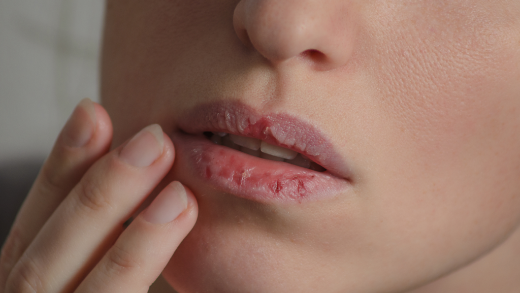 The wrong lip balm can cause more harm than good
