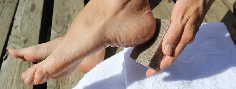 Rough soles and cracked heels